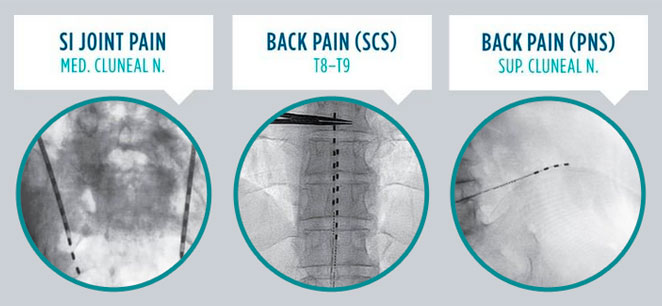 Chronic pain solution: Spinal cord stimulators (SCS) versus